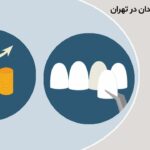 قیمت لمینت دندان در تهران