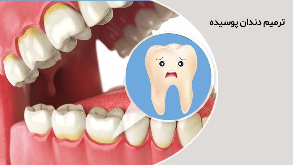 ترمیم دندان پوسیده