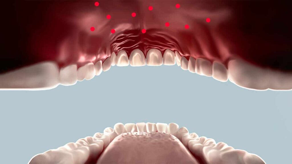 راه های جلوگیری از ایجاد لکه قرمز روی سقف دهان