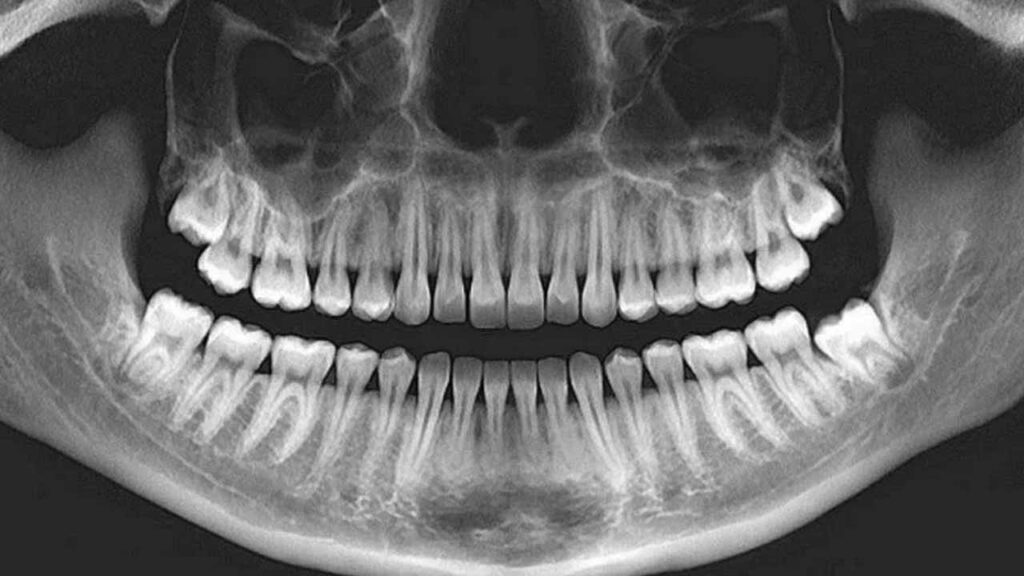 عکس opg دندان چیست؟
